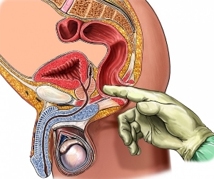 Massage de la prostate